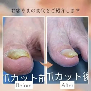 巻き爪でお悩みではないですか？