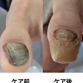 その親指の爪、分厚くなっていませんか？