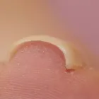巻き爪